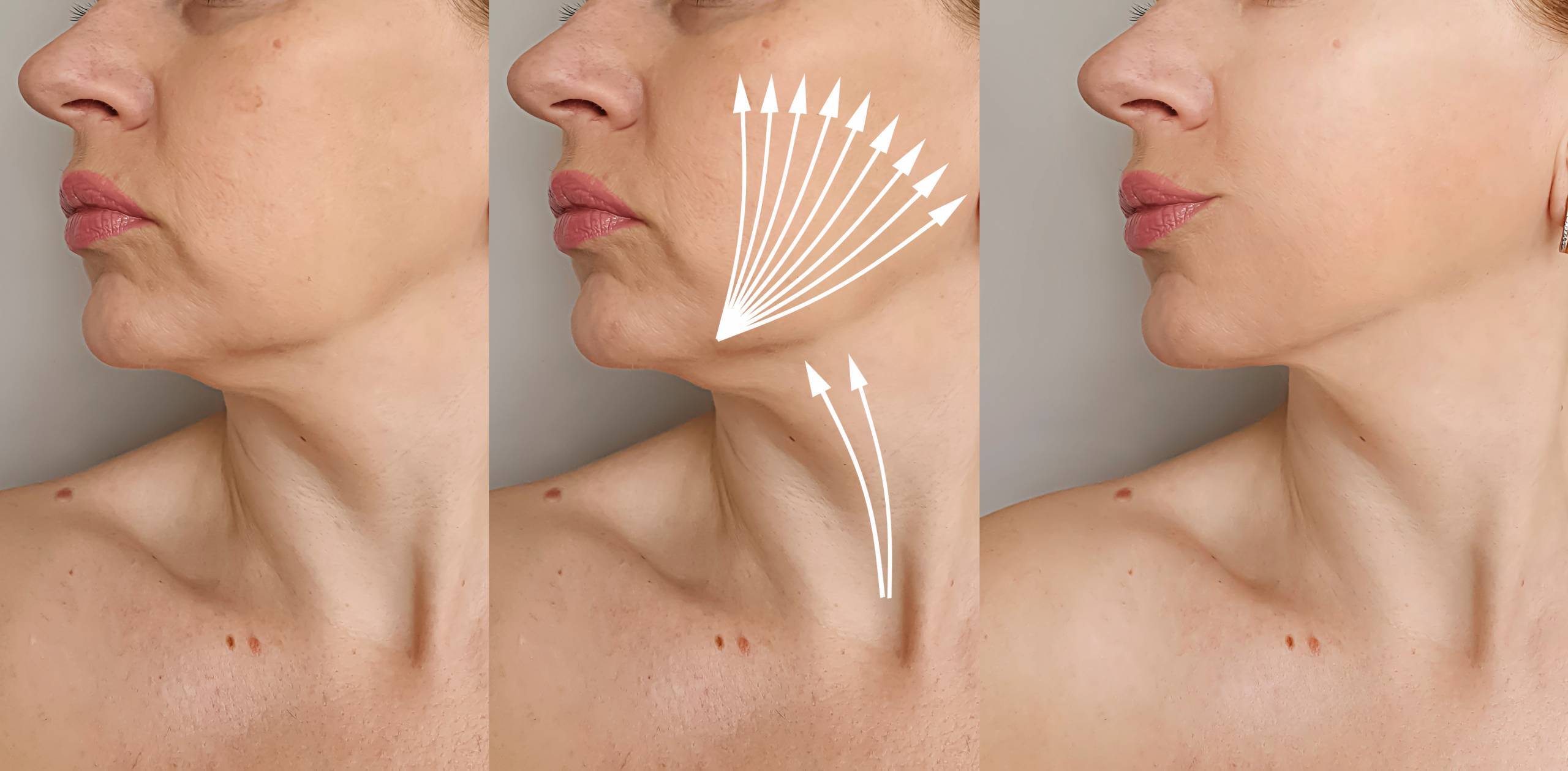 Double Chin Treatment