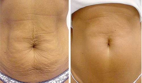 Skin Tightening