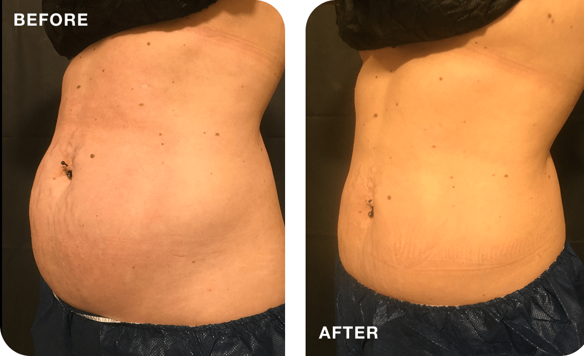 Belly fat freezing before and after results Melbourne