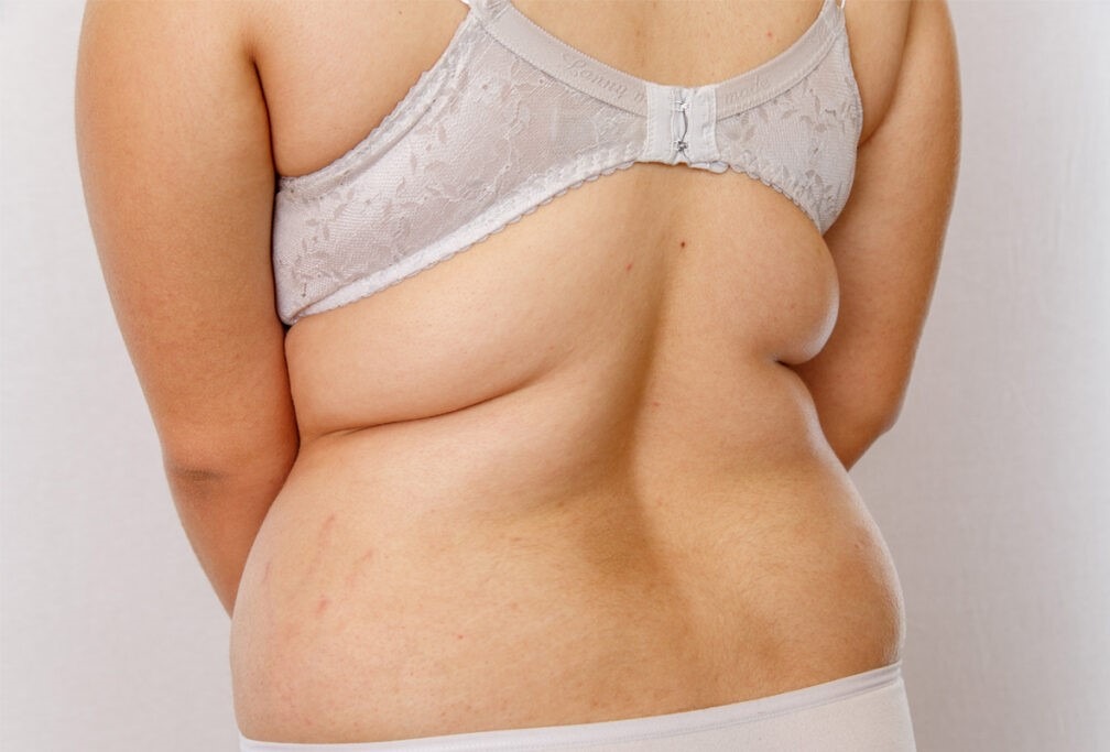 Back fat freezing treatment process Melbourne clinic