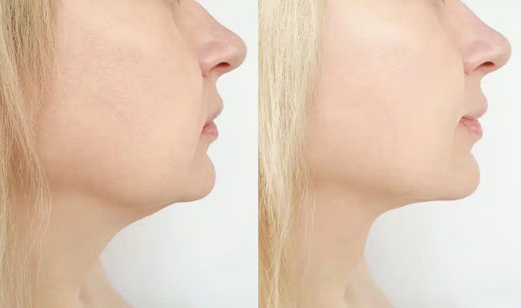 Chin fat freezing before and after jawline results Melbourne