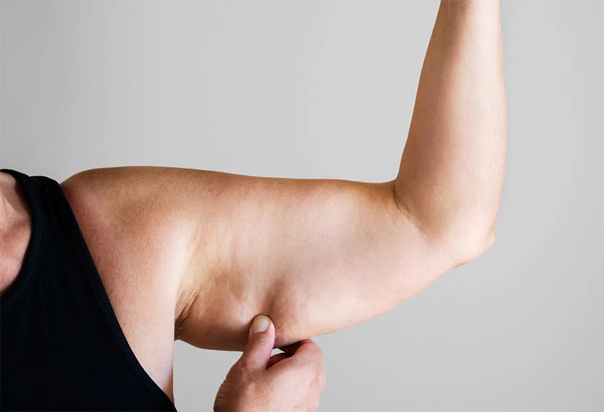 Arm fat freezing bat wings treatment Melbourne