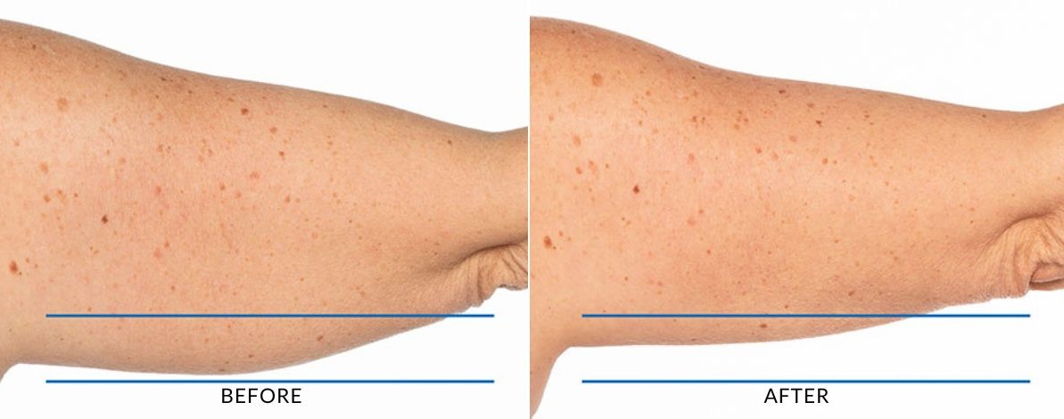 Arm fat freezing before and after results Melbourne