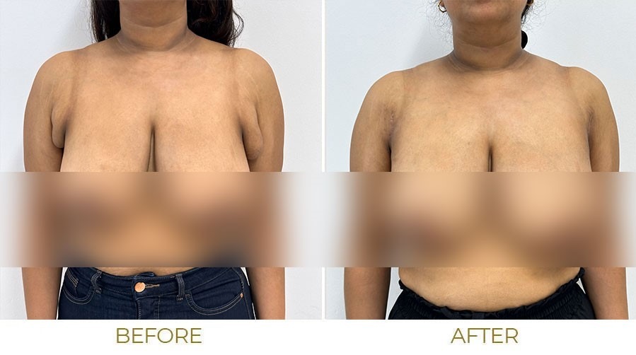 Bra fat freezing before and after results Melbourne