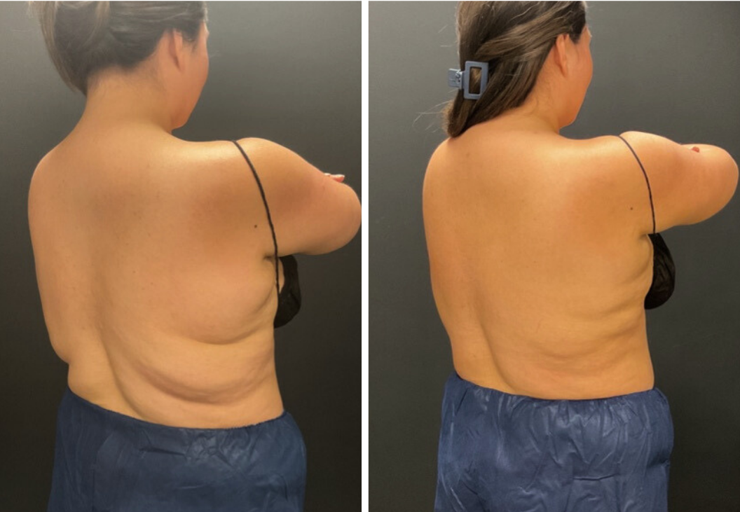 Back fat freezing before and after results Melbourne