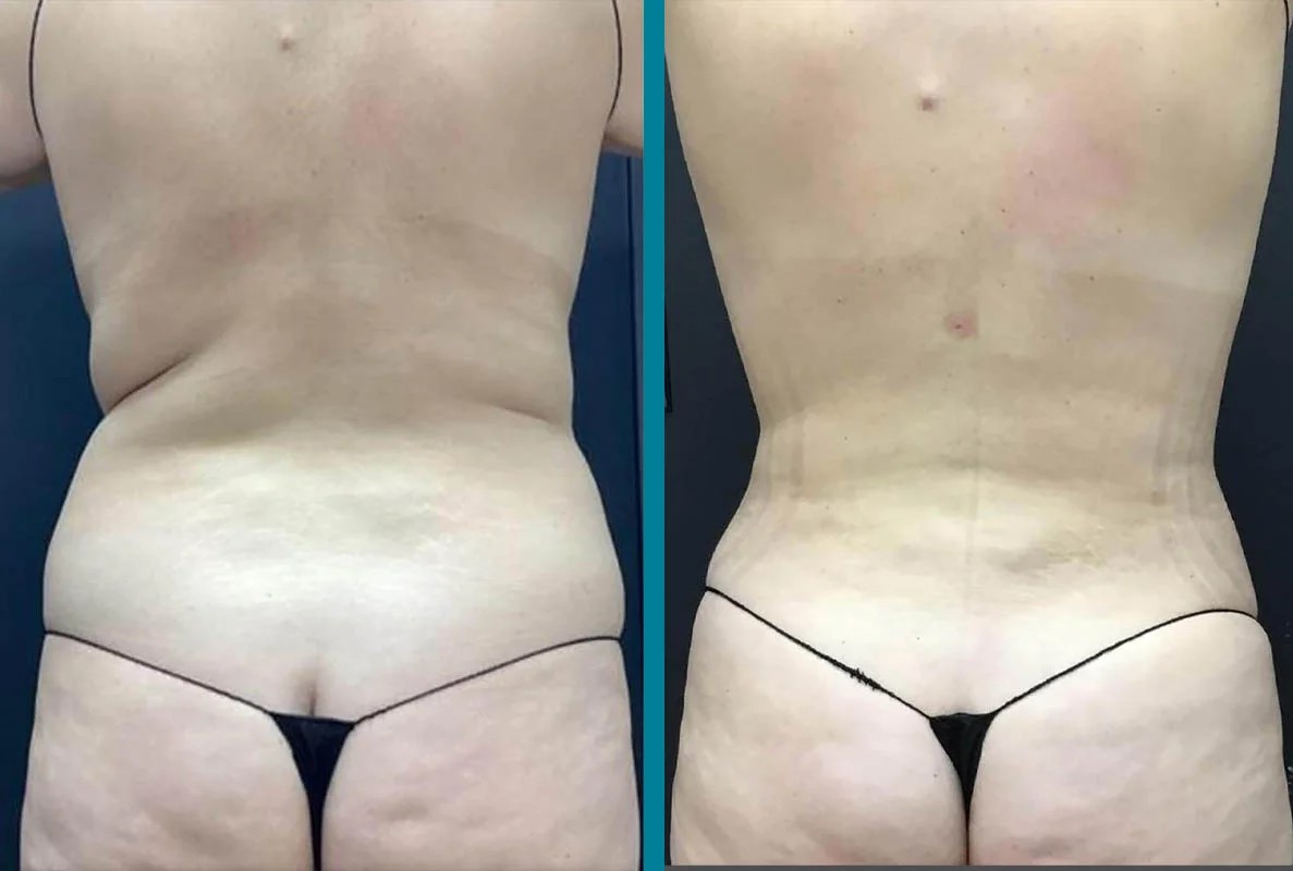 Love handle fat freezing before and after results Melbourne
