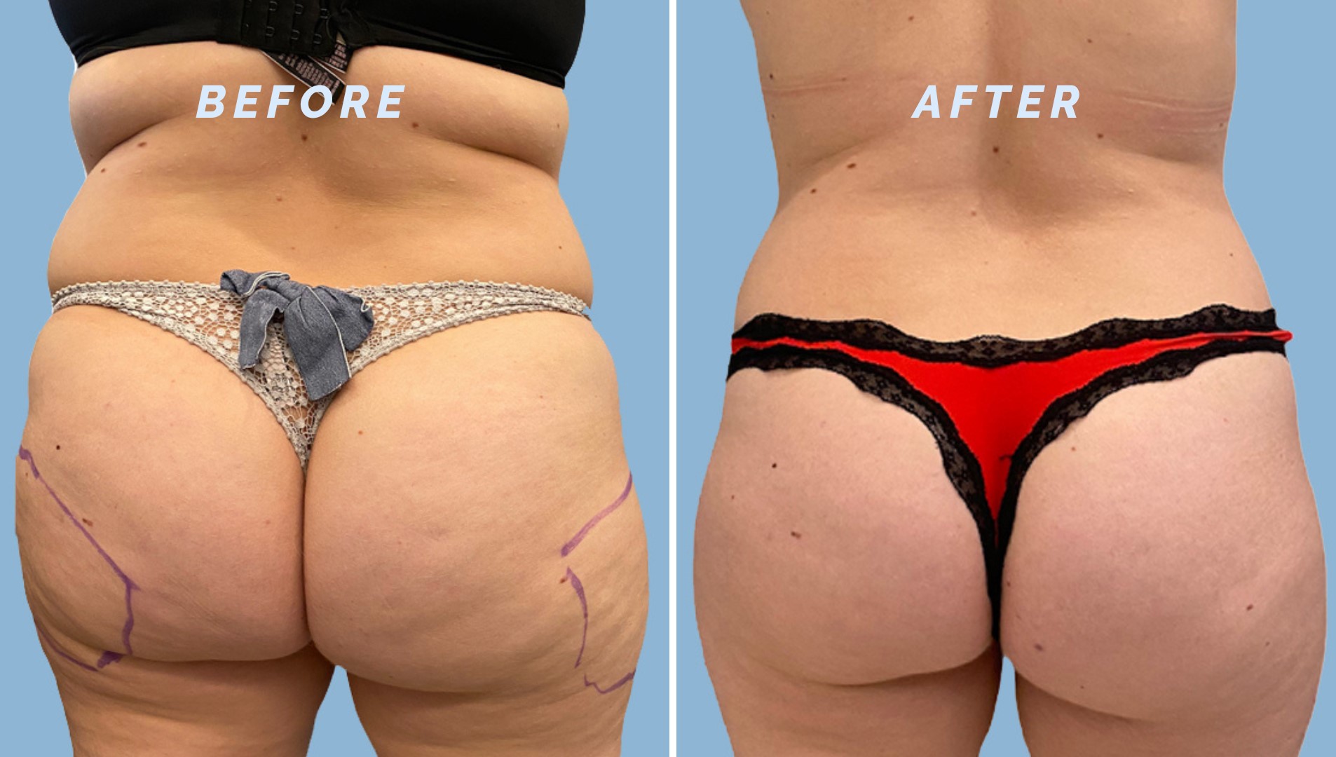 Fat freezing thighs before and after results Melbourne